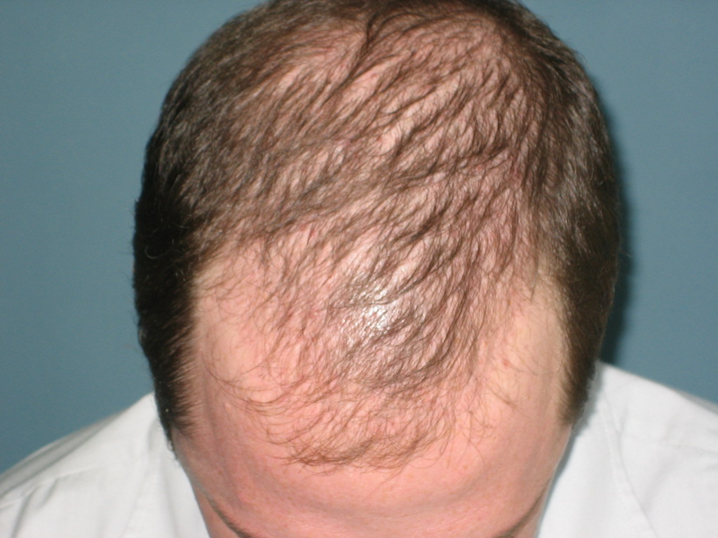 what are the different types of alopecia what are the different types of alopecia